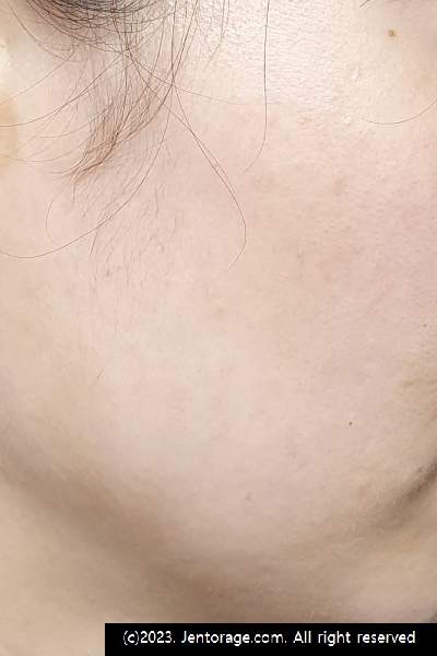 편평사마귀 제거 후기 2