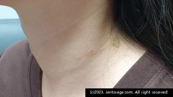 편평사마귀 제거 후기 4