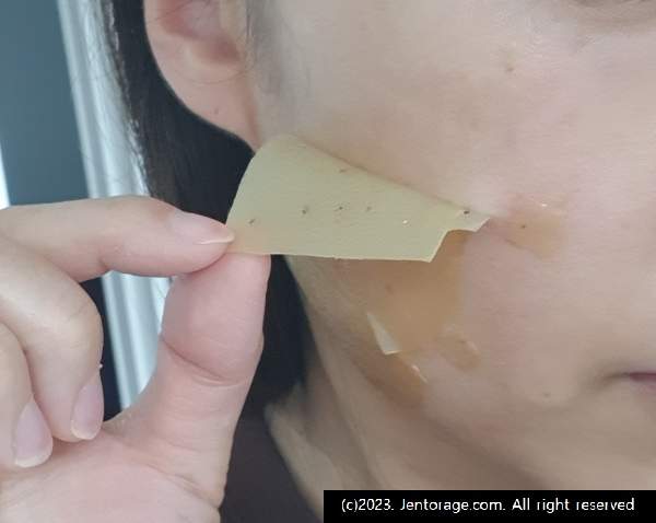 편평사마귀 제거 후기 5